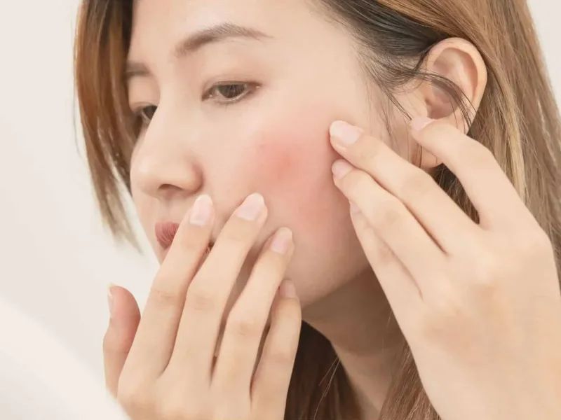 Woman with bad skin